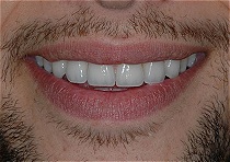teeth after procedures: correct headaches, migranes, sleep apnea, bruxing and tmj problems